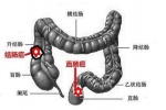 身體出現(xiàn)哪些信號提示直腸癌呢？